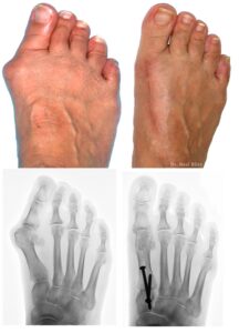 Opération de l'hallux valgus par le docteur Neal Blitz