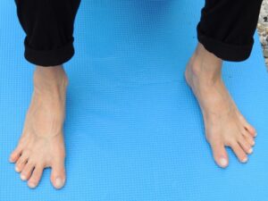 Corriger l'hallux valgus-Commander le muscle qui écarte le gros orteil-Cours et Stages-Yoga-Yvette Clouet-13005 Marseille