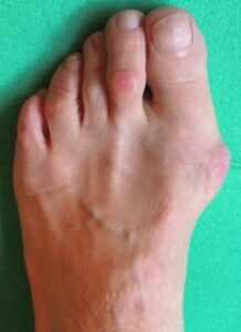 Hallux Valgus- Stage de Yoga à Marseille avec Yvette Clouet