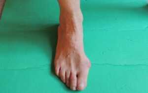 Hallux Valgus - Stage de Yoga à Marseille avec Yvette Clouet