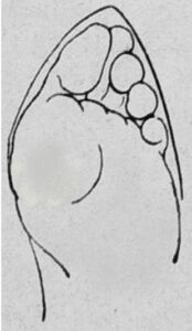 Hallux valgus : le pied a pris la forme de la chaussure-Cours et Stages-Yoga-Yvette Clouet-13005 Marseille